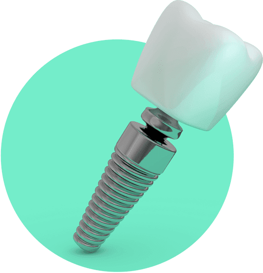 Illustration eines Zahnimplantats